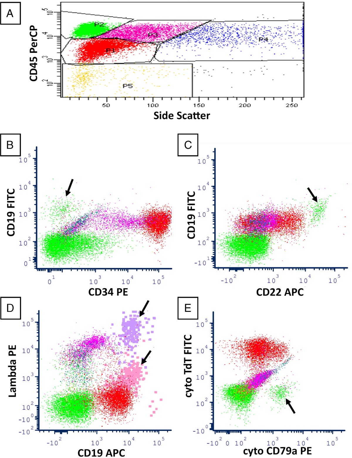 When Flow Is Turbulent: CD19 Intensity Is a Pitfall in Acute Leukemia Classification