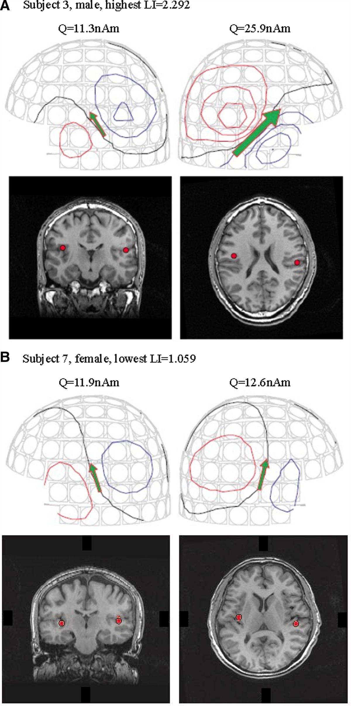 Clinical standardization for the detection of hemispheric dominance for steady-state auditory evoked fields in normal hearing